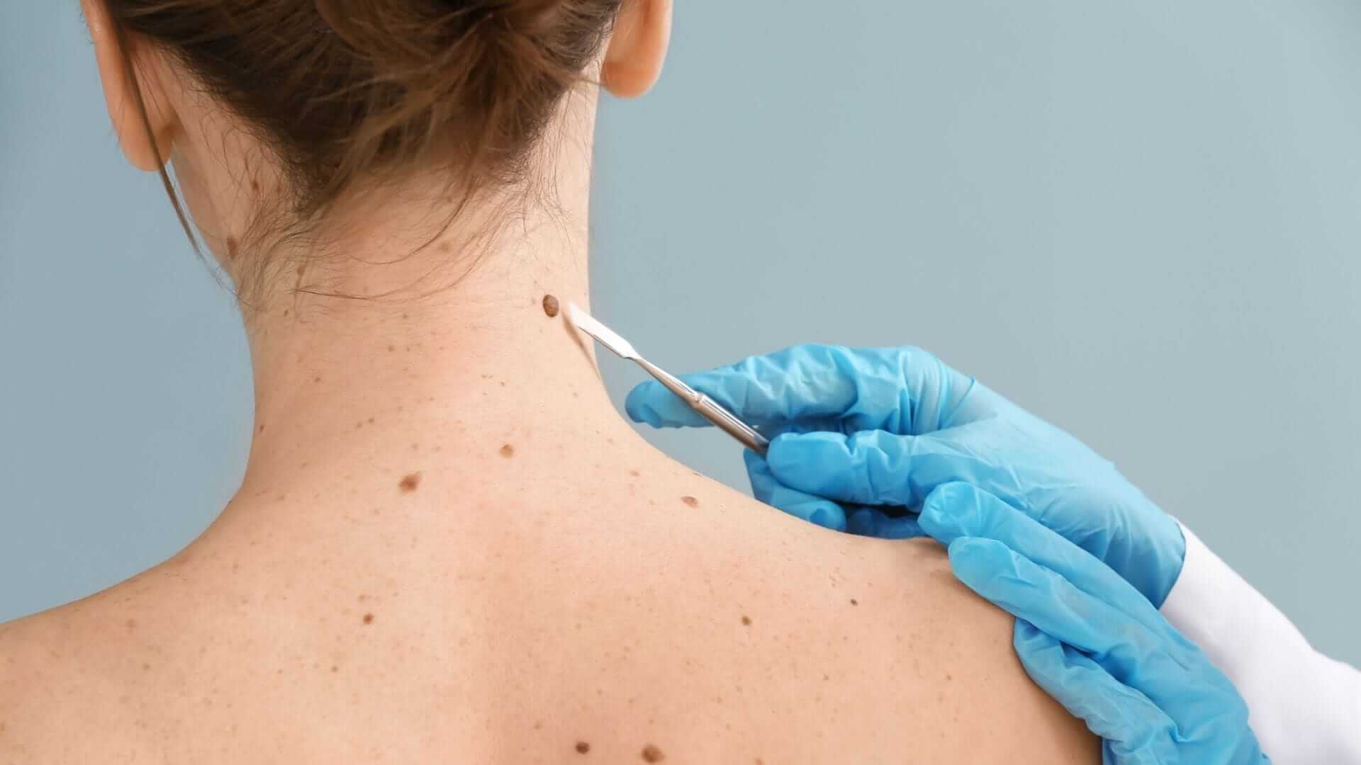  A medical professional in blue gloves uses tweezers to examine a mole on a patient's back, representing an examination for potential skin cancer, which is a necessary step in determining the stages and associated treatment expenses.